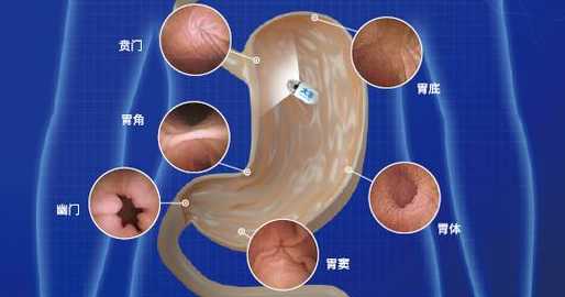 特殊位置的消化性溃疡简介