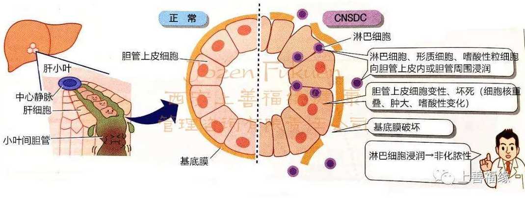 什么是原发性胆汁性肝硬化?